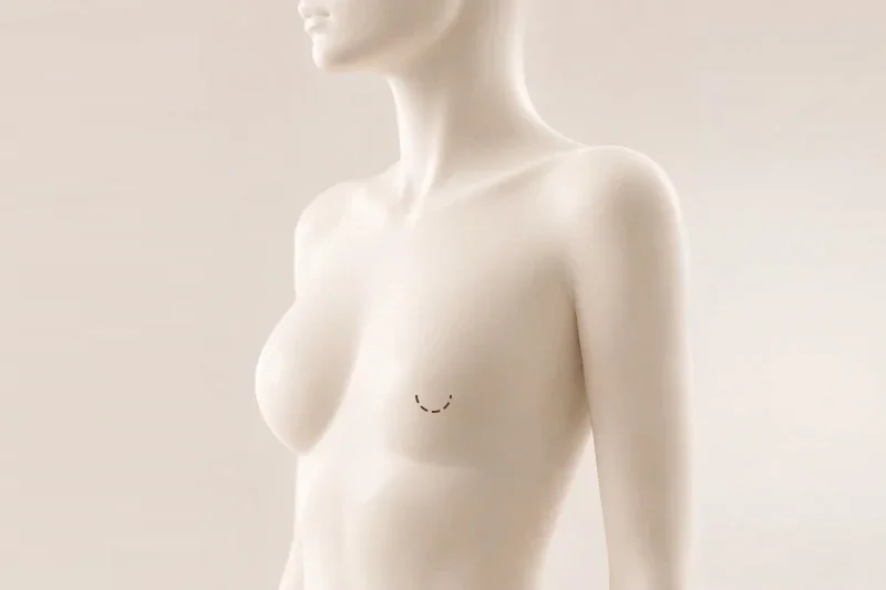 유륜 절개