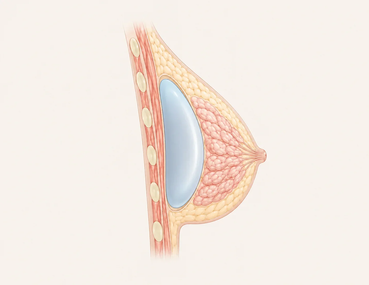 근막하/유선하 (Subfascial/Subglandular)