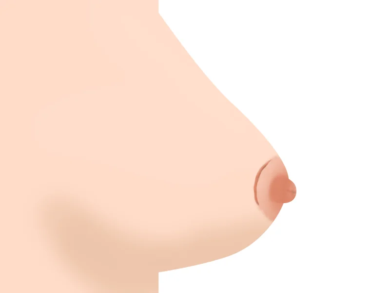 수술 후 유륜 주변 흉터