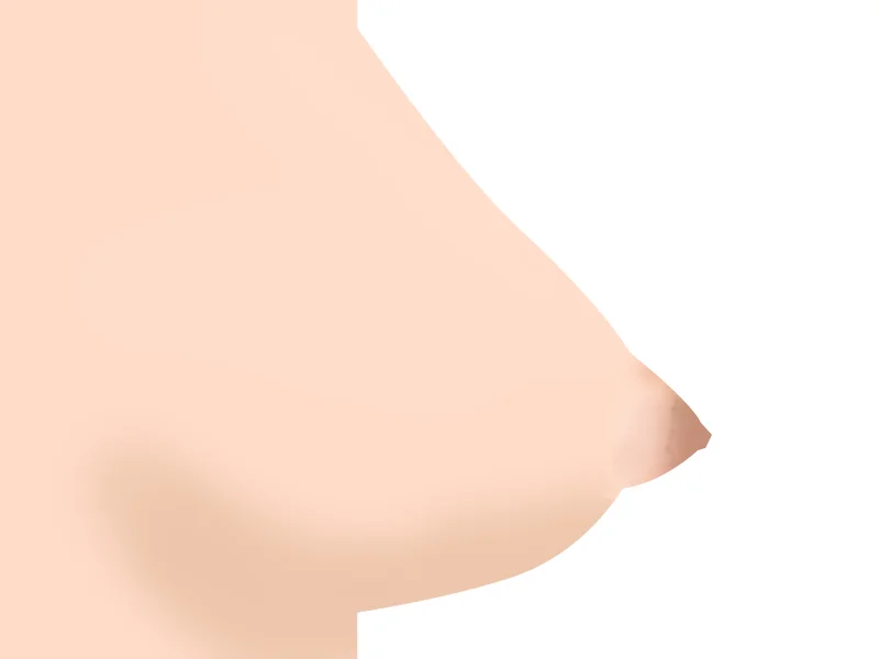 유륜 탈장